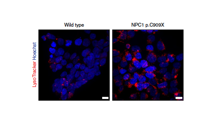 Confocal microscopy of wild-type vs NPC1 p.C909X cells stained with LysoTracker (red) and Hoechst (blue), showing lysosomal cholesterol accumulation in the variant.